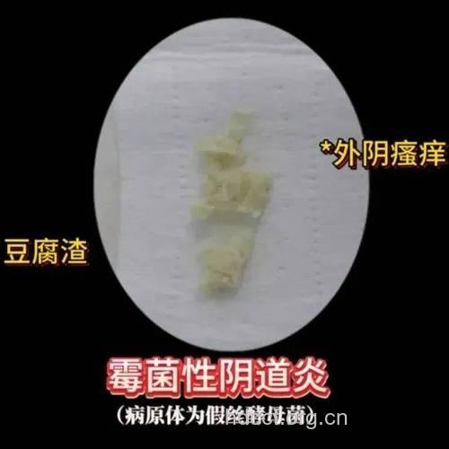 什么是化脓性阴道炎