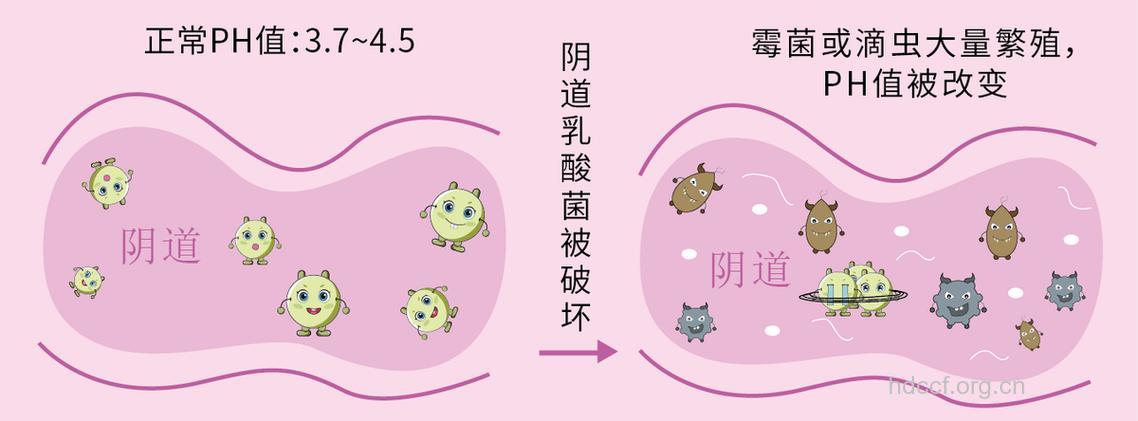 女人必修：避免阴道菌群失调