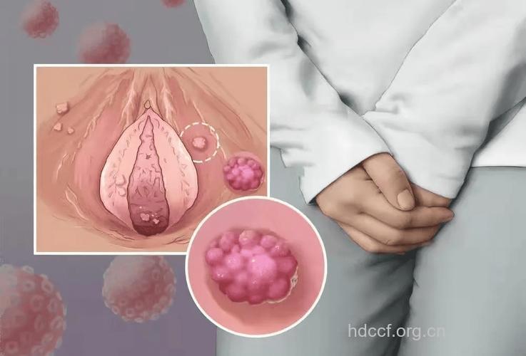 女性外阴易患的5大疾病