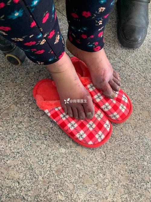 穿长靴易长冻疮