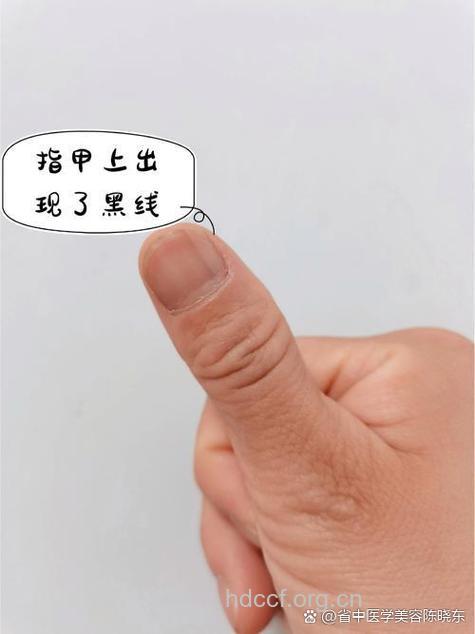 指甲下面长黑线是怎么回事