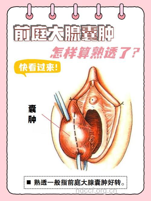 前庭大腺囊肿不疼不痒需要手术吗？