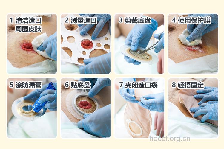 前庭大腺囊肿造口术是什么？