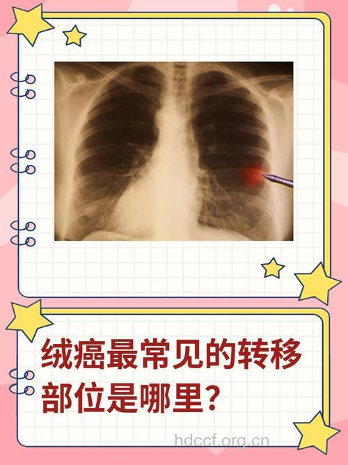 绒毛膜癌常见的转移部位有哪些