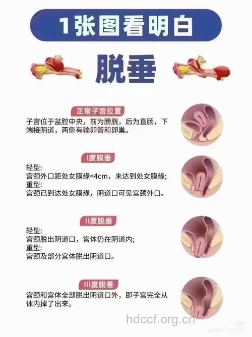 子宫脱垂要怎么治疗