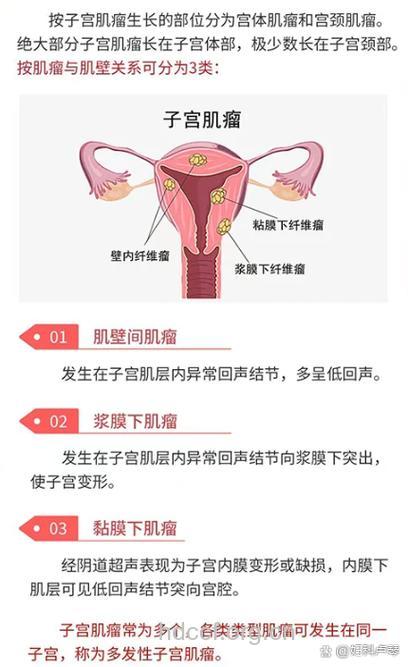 子宫肌瘤最爱找上三种女性