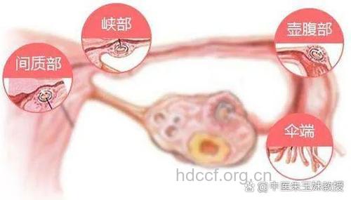 输卵管不通自查方法 自觉下腹压痛体温高