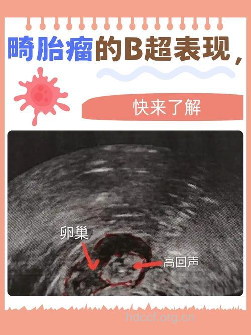 卵巢畸胎瘤能怀孕吗？孕前须积极检查