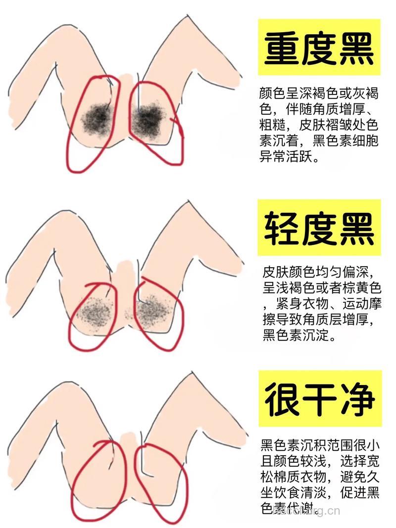 大腿根部皮肤变黑是怎么回事