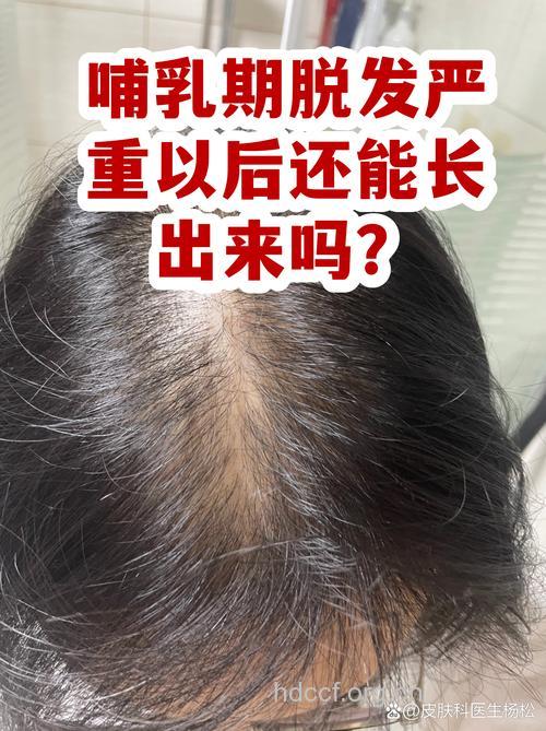 哺乳期脱发正常吗