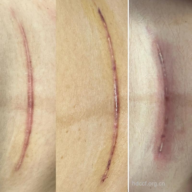 无痛人流会留下疤痕吗