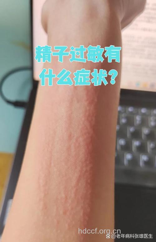女性对精液过敏是怎么回事