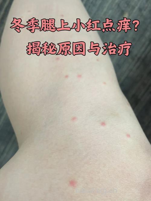 冬季皮肤痒怎么办？