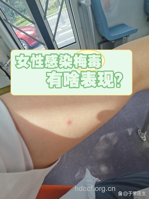 女人染上性病的六大迹象