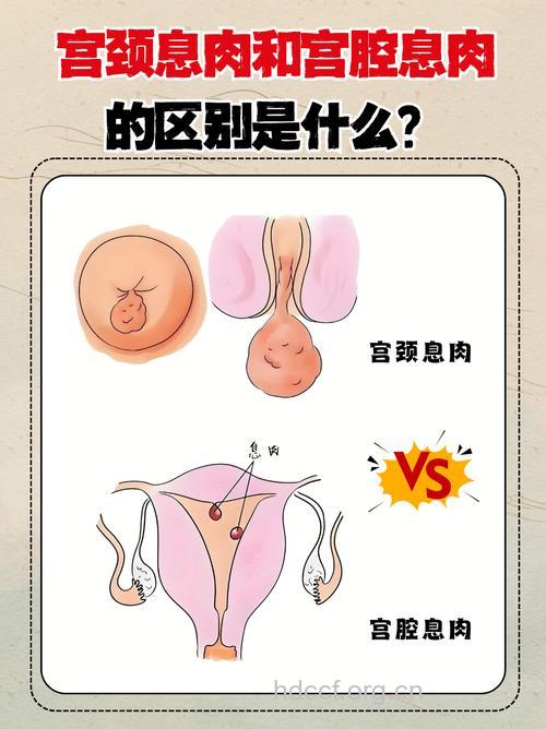 子宫颈息肉长在哪里