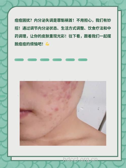 脸上长痘痘 是内分泌失调在作怪?