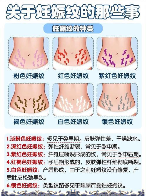 两招帮你搞定妊娠纹