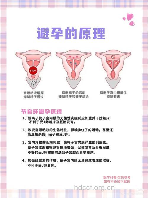 女性避孕“上环”的护理常识