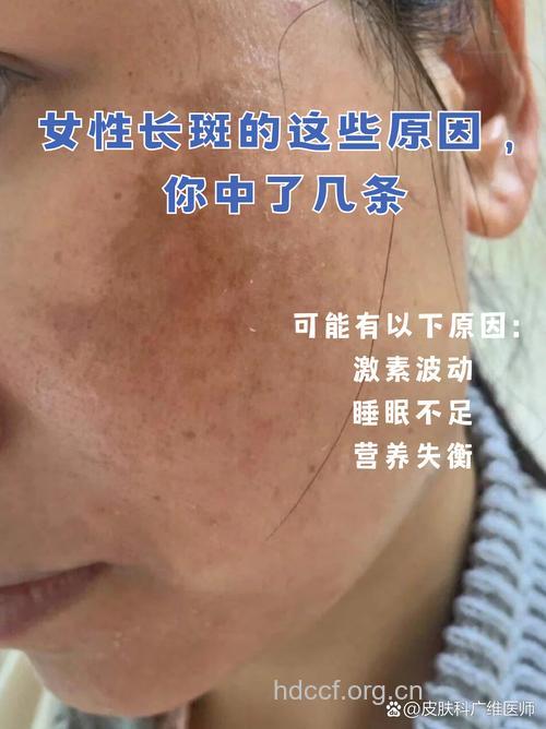 揭秘:穿太少的女性易长斑