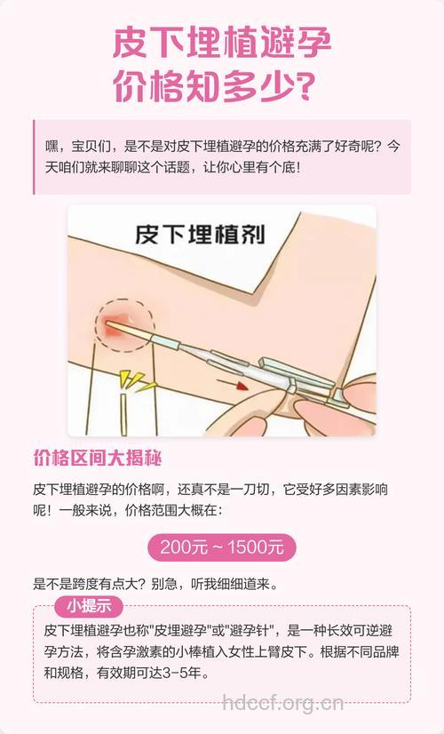 皮下埋植避孕法基本常识