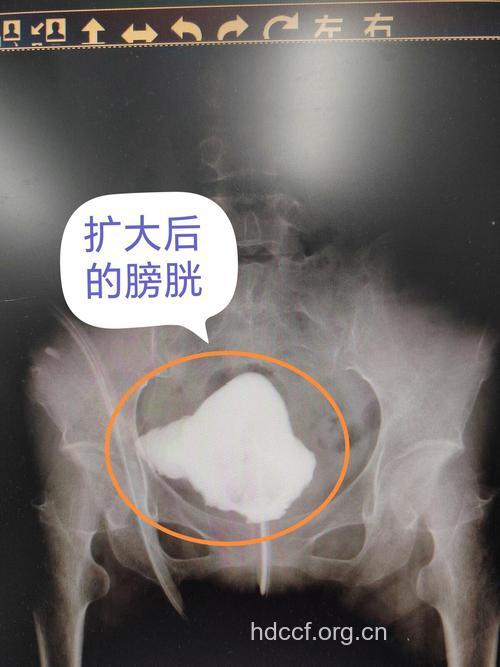 谨慎：请勿陷入阴道炎怪圈