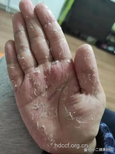 冬季手脚脱皮多吃胡萝卜