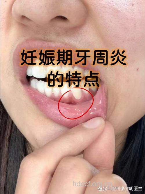 孕期患牙周炎可致早产