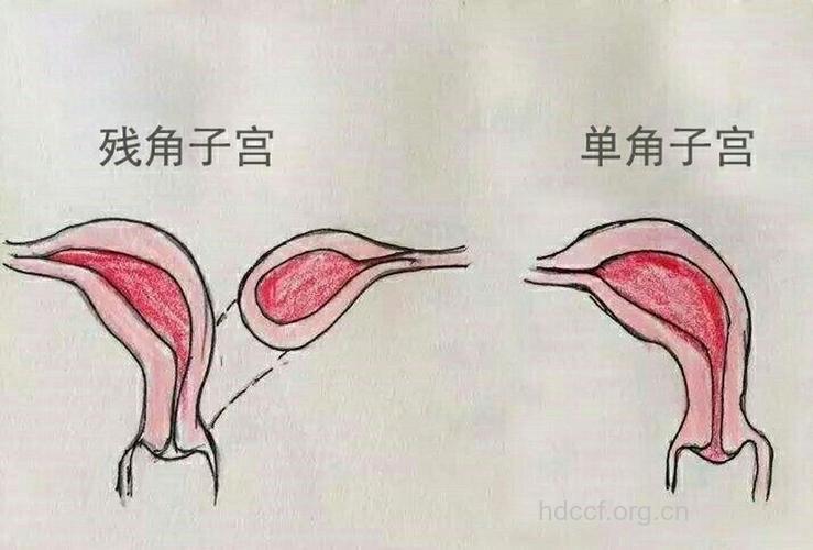 残角子宫女性如何怀孕？