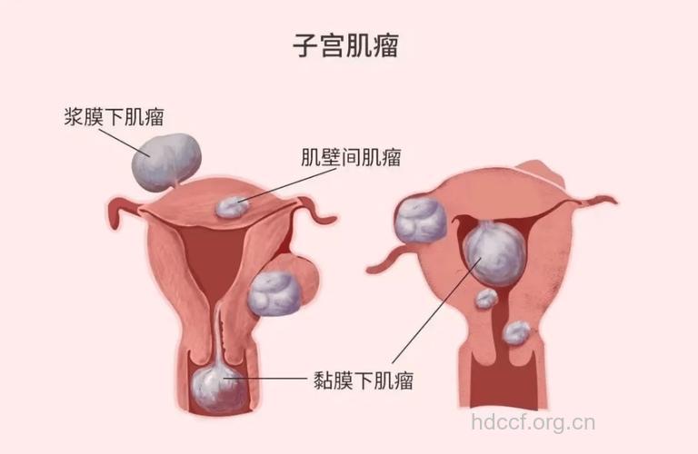 女性生殖健康杀手 子宫肌瘤