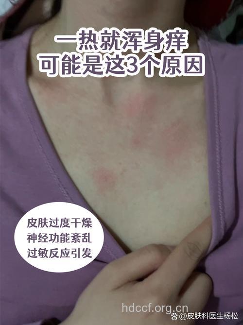 天热！当心沦为＂痒＂女人