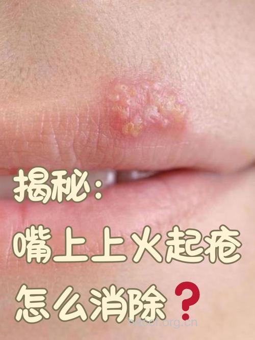秋季上火长痘烂嘴角怎么办