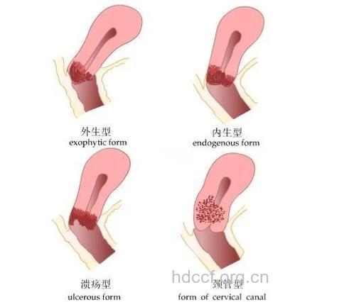 如何防青春期子宫出血?