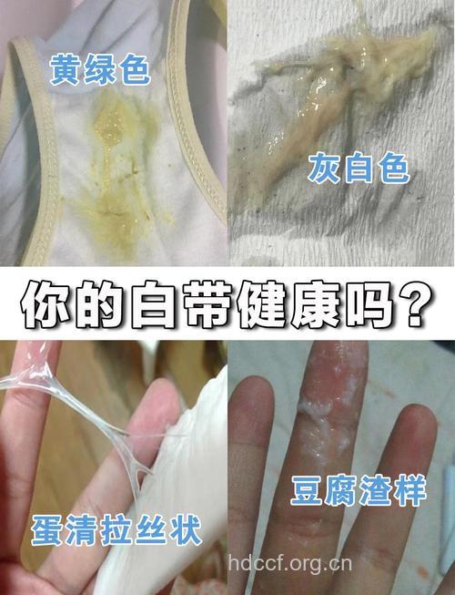 白带异常的几种状况