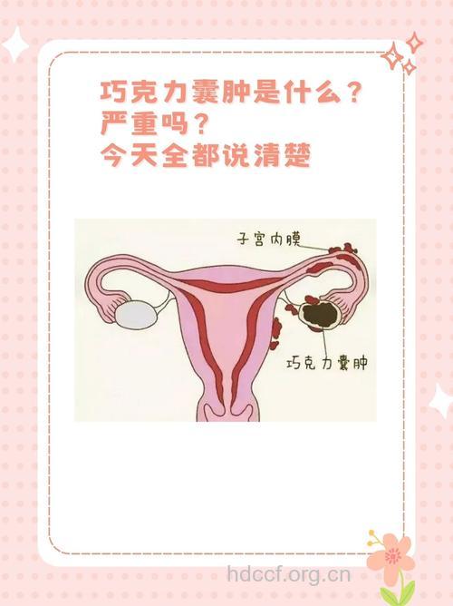 巧克力囊肿 女性痛经加剧的凶手