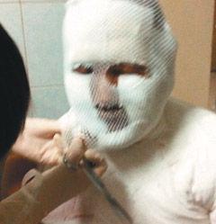 齐秦烧伤照曝光满脸纱布 脸上仍有伤疤