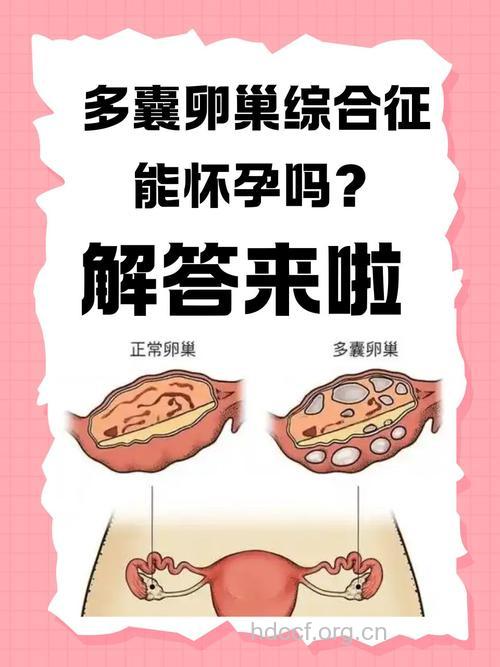 多囊卵巢综合症能怀孕吗？