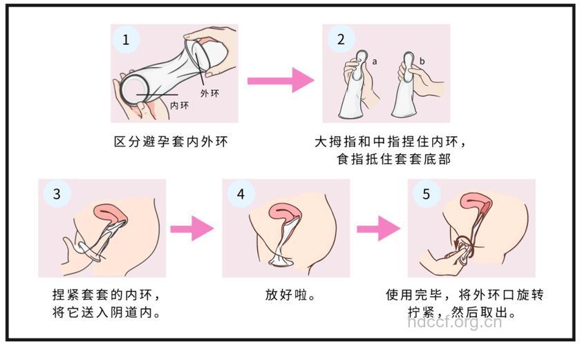 女性避孕套 更贴心