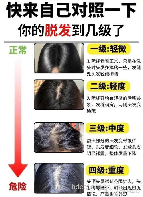 女性头发少怎么办 植发到底好不好