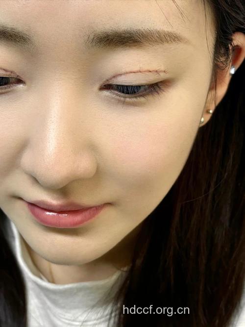 女人不要乱割双眼皮 割双眼皮风险大