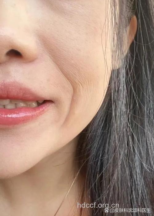 愁眉苦脸容易长皱纹 女人笑一笑好处多