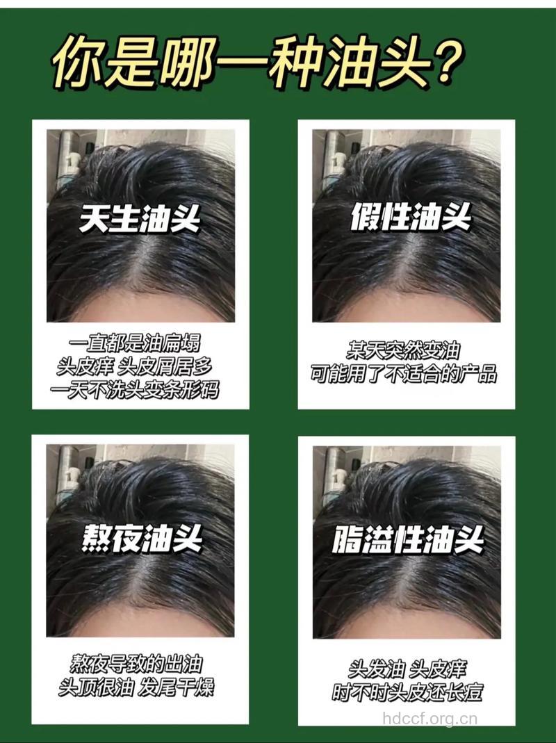 头发爱出油怎么办 五招轻松解决