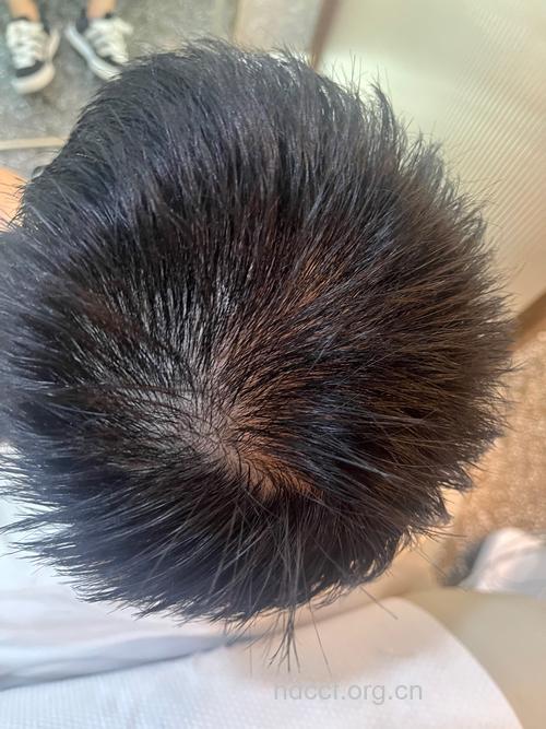 严重脱发 男人肾虚的6大症状