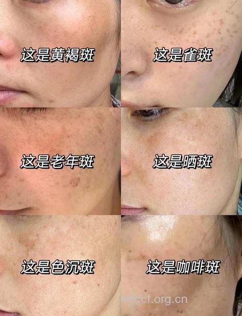 女人长斑又老又丑 教你几毛钱就能祛斑的方法