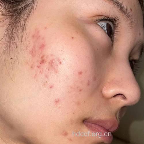 男性荷尔蒙分泌旺盛可致青春痘