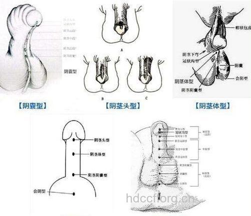 男性泌尿生殖器畸形是阳痿的病因吗