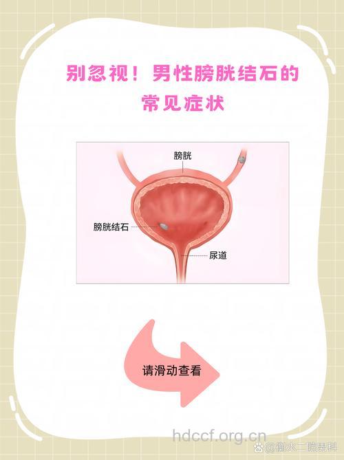 男性膀胱结石的症状有哪些
