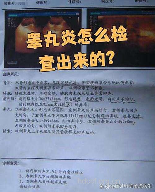 睾丸炎的检查项目有哪些