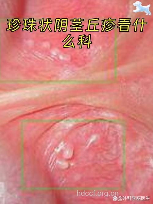 男性性病常见早期症状