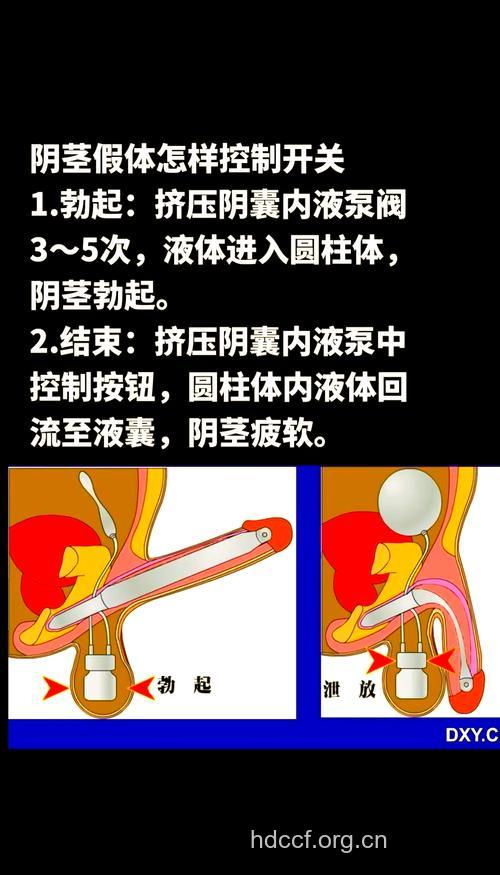 怎么阴茎假海绵体手术治疗阳痿
