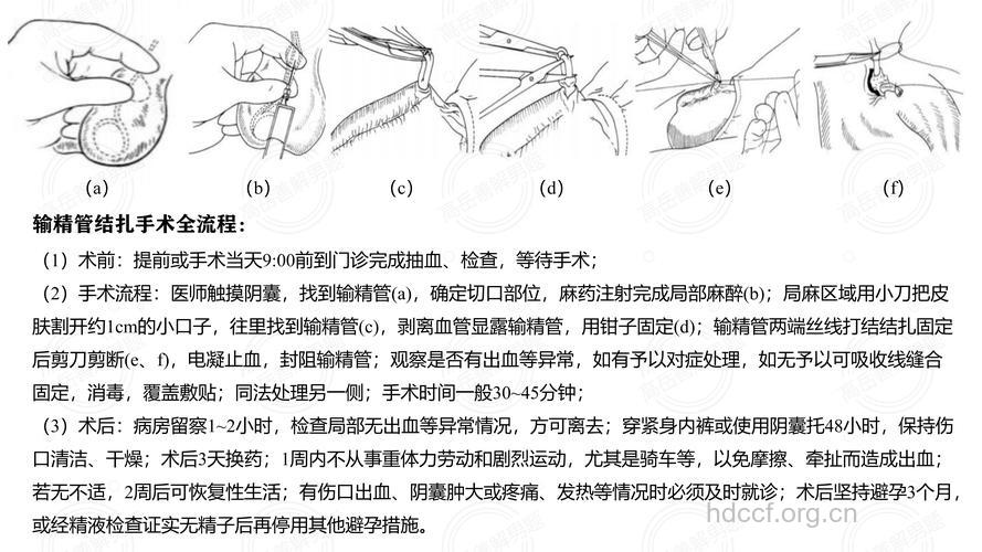 怎么用血管术治疗男性阳痿